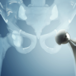Riabilitazione dopo protesi d'anca